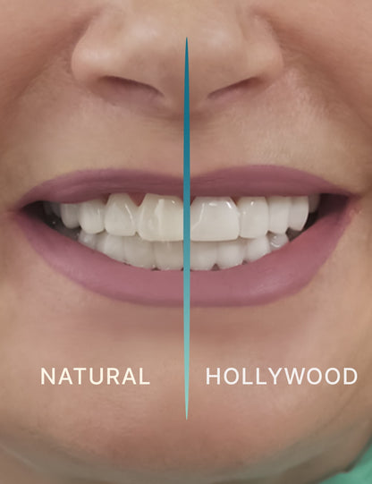 Teeth-Veneer 2.0